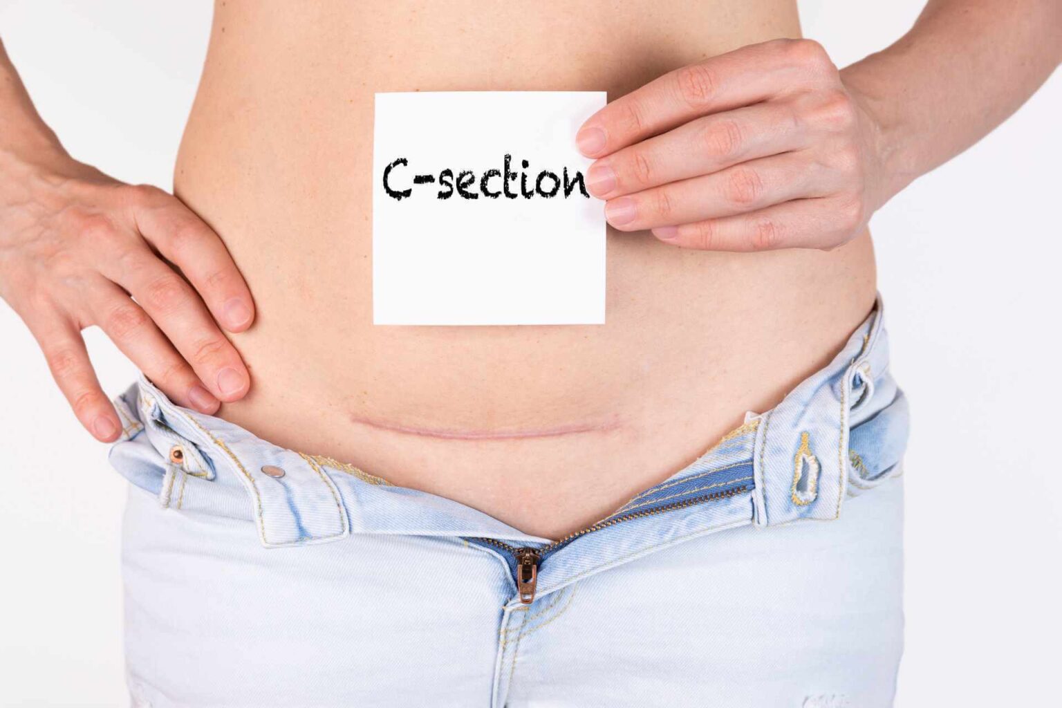 Can C Section Cause Headaches